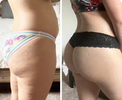 Antes y despues Maria | Redu Sculpt Resultados antes y después de Redu Sculpt en glúteos, reducción de celulitis y piel más firme.
